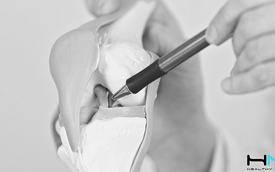 ¿Es la cirugía el mejor tratamiento tras la rotura del ligamento cruzado anterior de la rodilla?